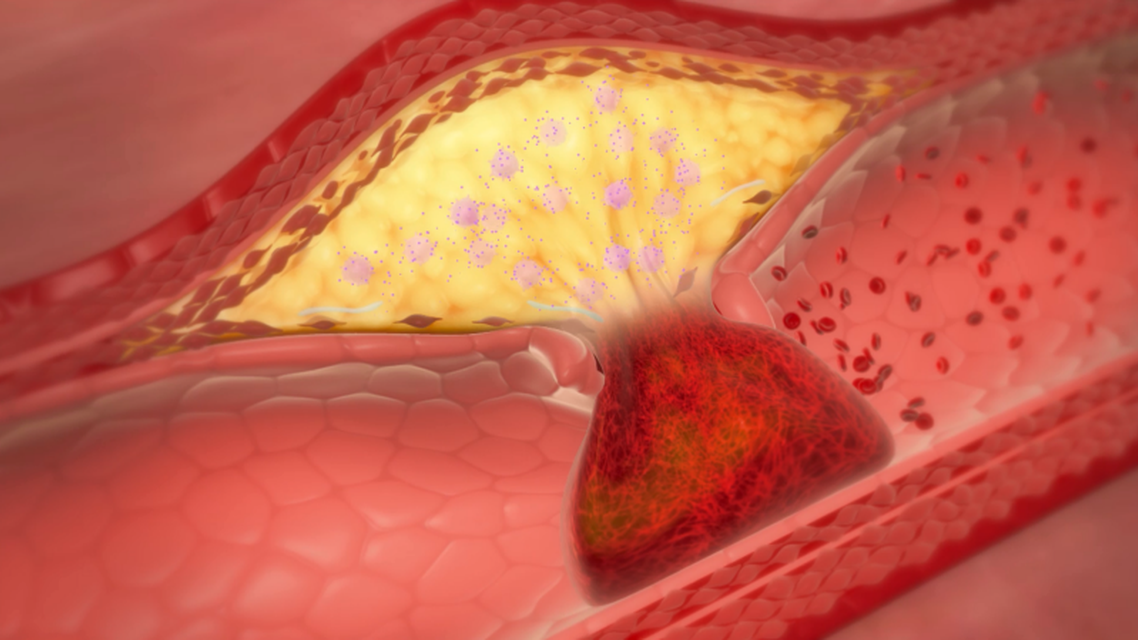 CReactive Protein Inflammation and Atherosclerosis