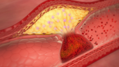 CReactive Protein Inflammation  and Atherosclerosis