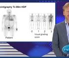 Cardiac amyloidosis an emerging target in HFpEF