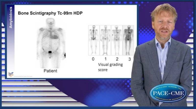 Cardiac amyloidosis an emerging target in HFpEF