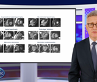HCM Understanding the condition
